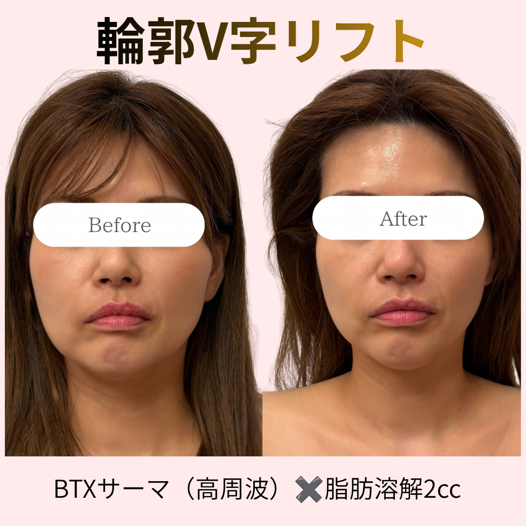 【事例紹介】フェイスラインのもたつき撃退！刺さずに痛みやダウンタウンのない施術で叶えるシャープな小顔輪郭